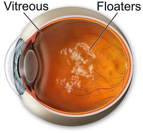 vitreo retinal disease doctors.